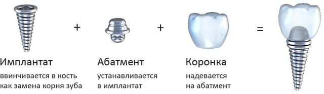 Имплантация зубов